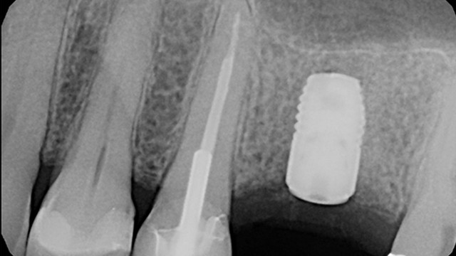 dental implants