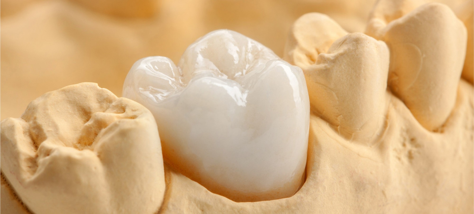 cerec crowns